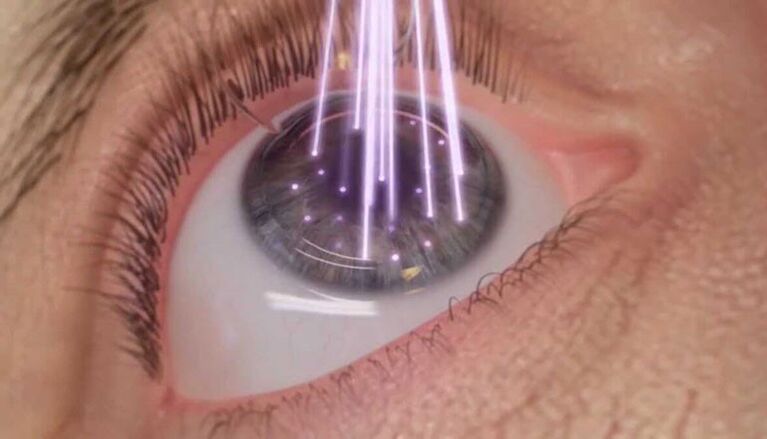 Laser eye surgery